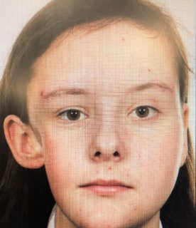 facial asymmetry